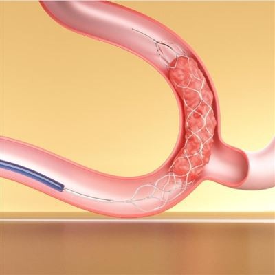 Stent Retriever Czesanie za pomocą cewnika aspiracyjnego